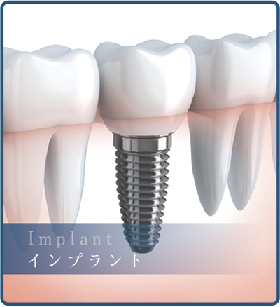 インプラント - 川瀬歯科医院｜小田原市｜歯科 歯医者