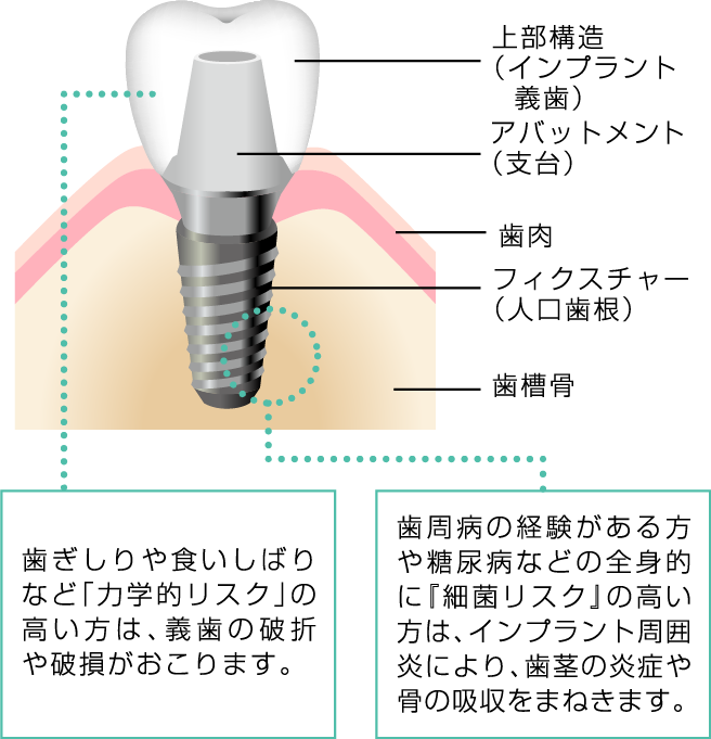 医療法人 西村歯科心斎橋診療所インプラント インプラント セカンド
